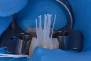 formation dpc dentisterie adhésive dans la restauration dent dépulpée