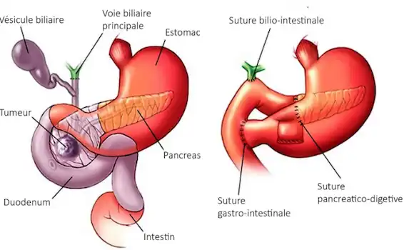 DPC operation : duodénopancréatectomie céphalique bilio-intestinale gastro-intestinale pancreatico-intestinale